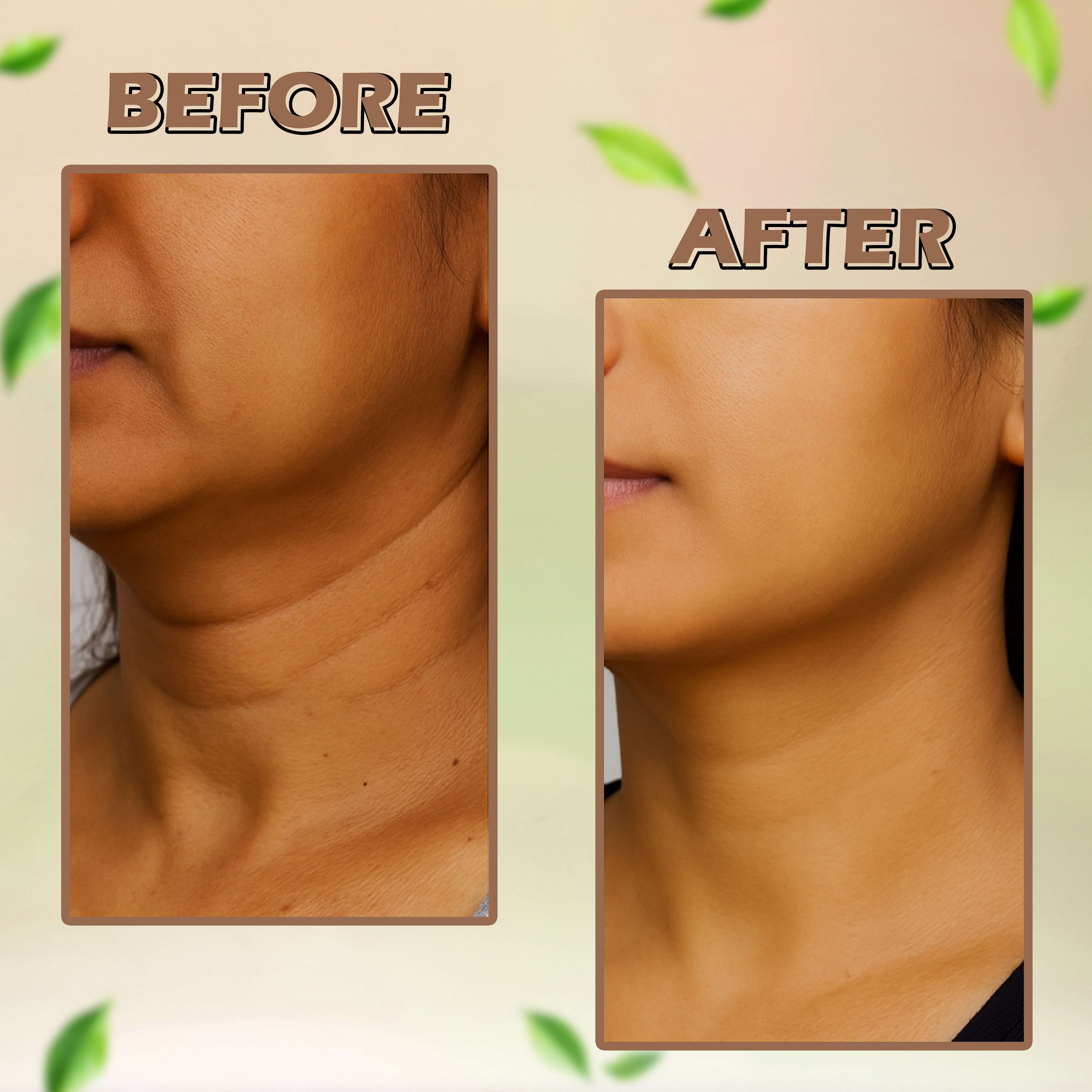 Before and after using AyuraGlow Ayurvedic Dark Spot Treatment, showcasing clear and even skin results for an effective pigmentation solution.