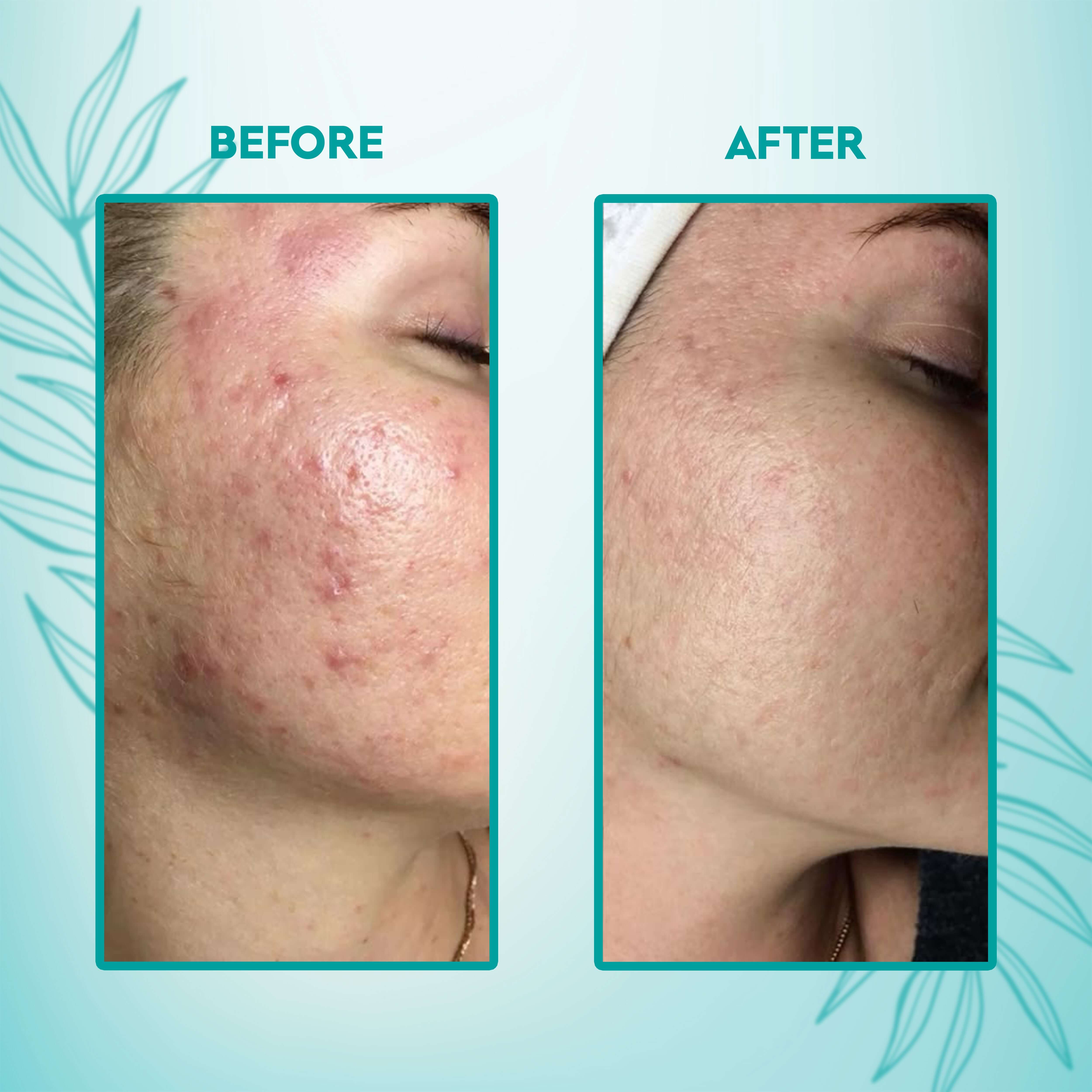 Before and after results of using NemAya Acne Treatment Pack by Aayogi Ayurveda, showing reduced acne and clearer skin.