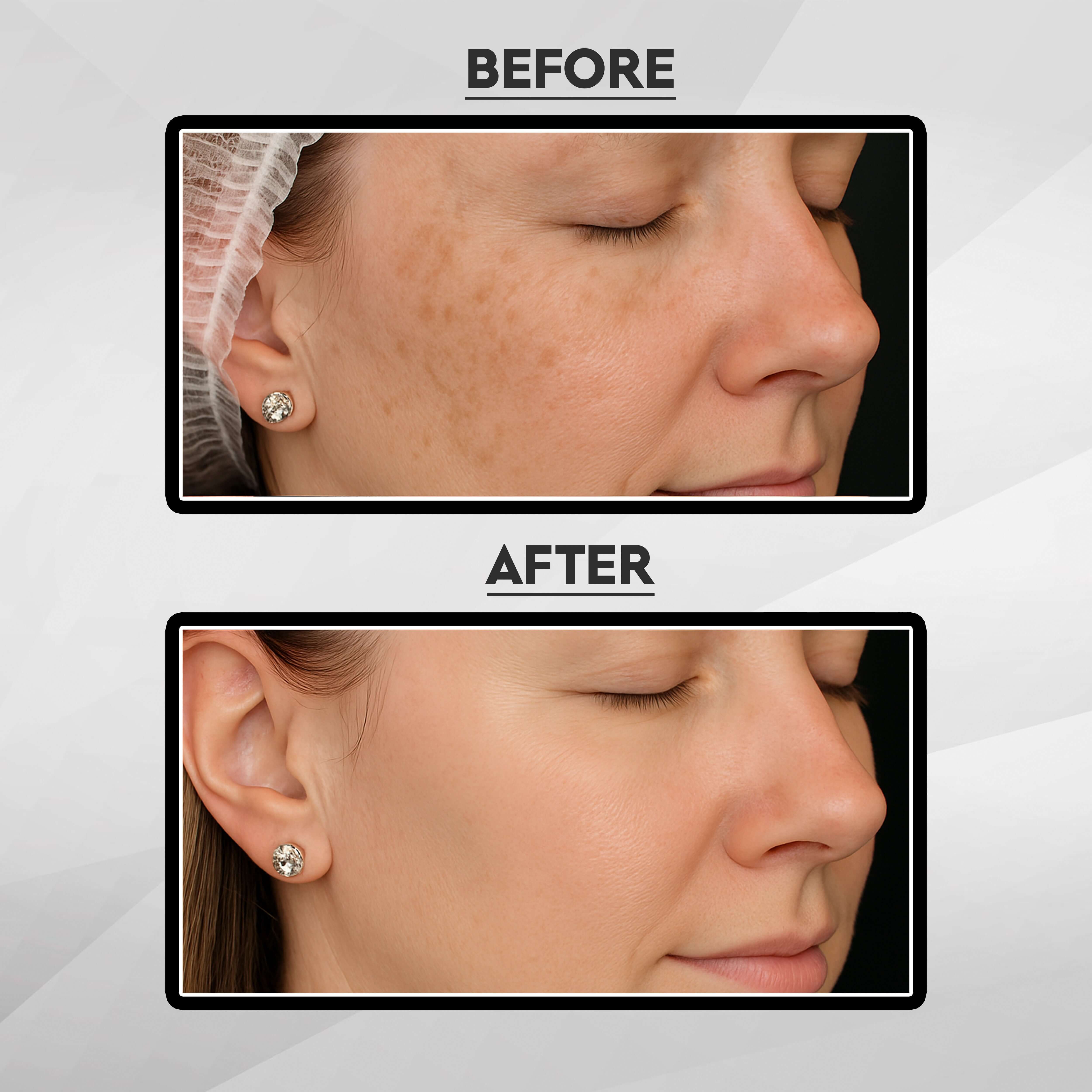 Before and after results of skincare treatment with improved skin texture and tone.