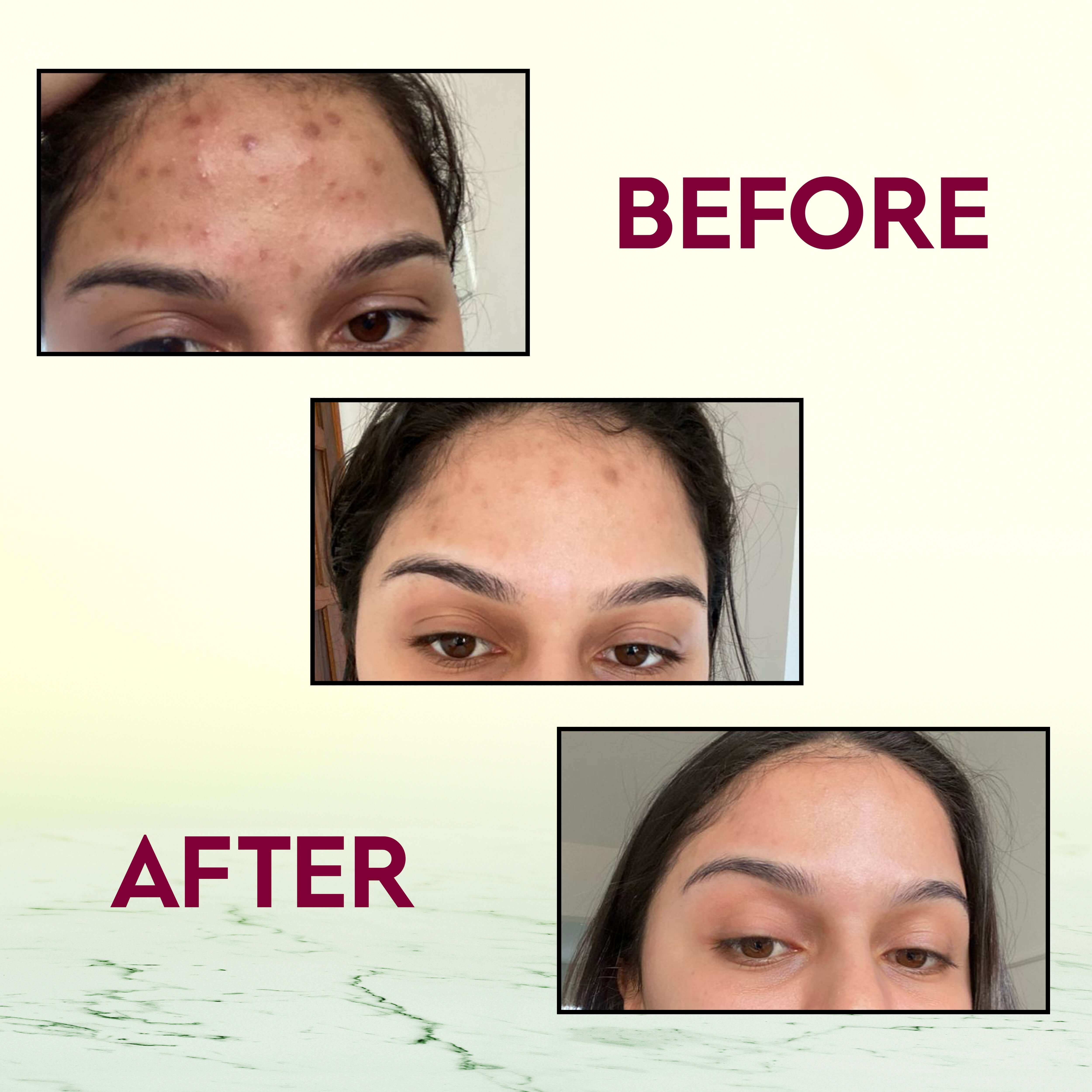 Before and after photos showing skin improvement using BeetGlow Beetroot Ubtan for skin brightening and glow.
