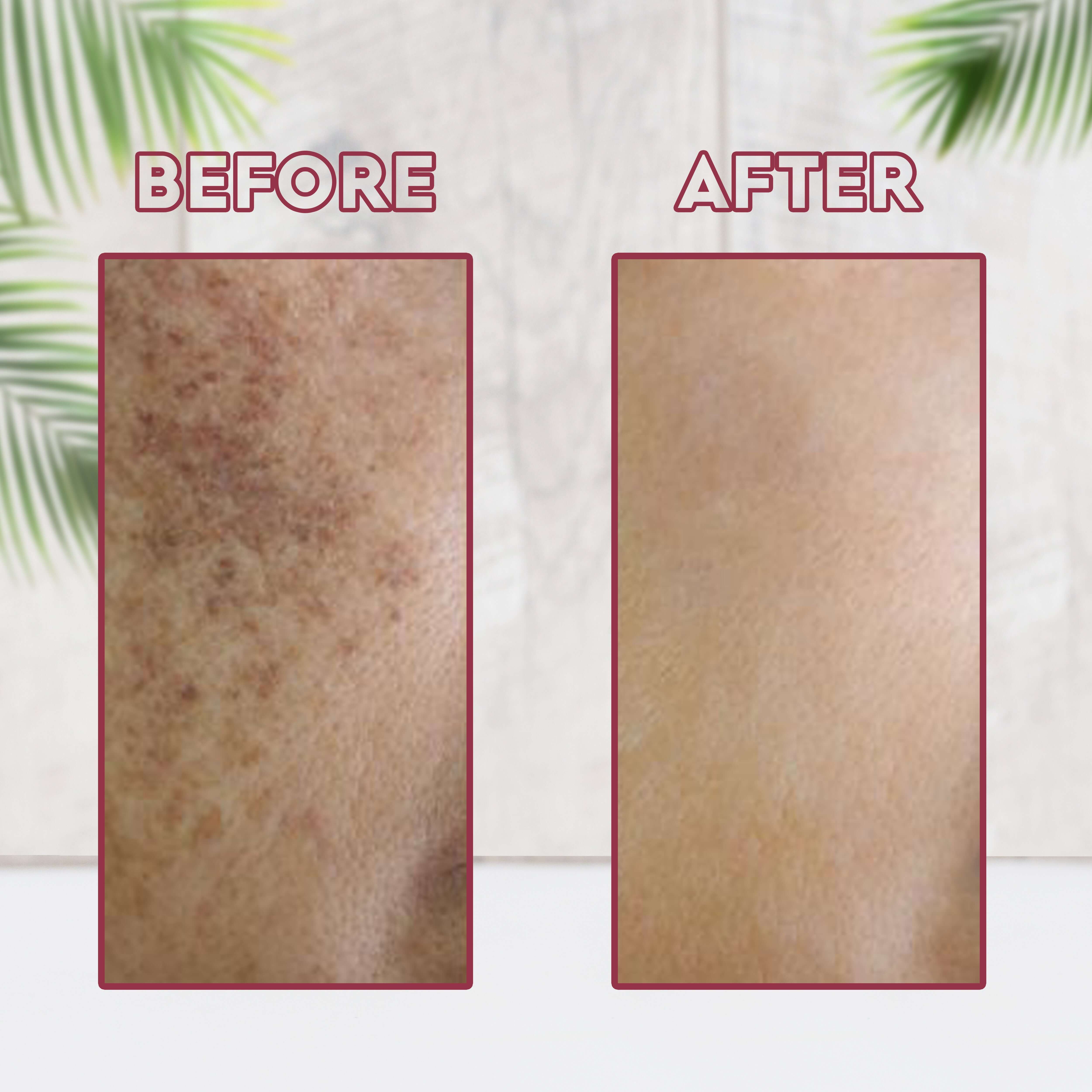 Before and after image showing skin improvement with BlushRoot Hibiscus Face Wash Powder by Aayogi Ayurveda.