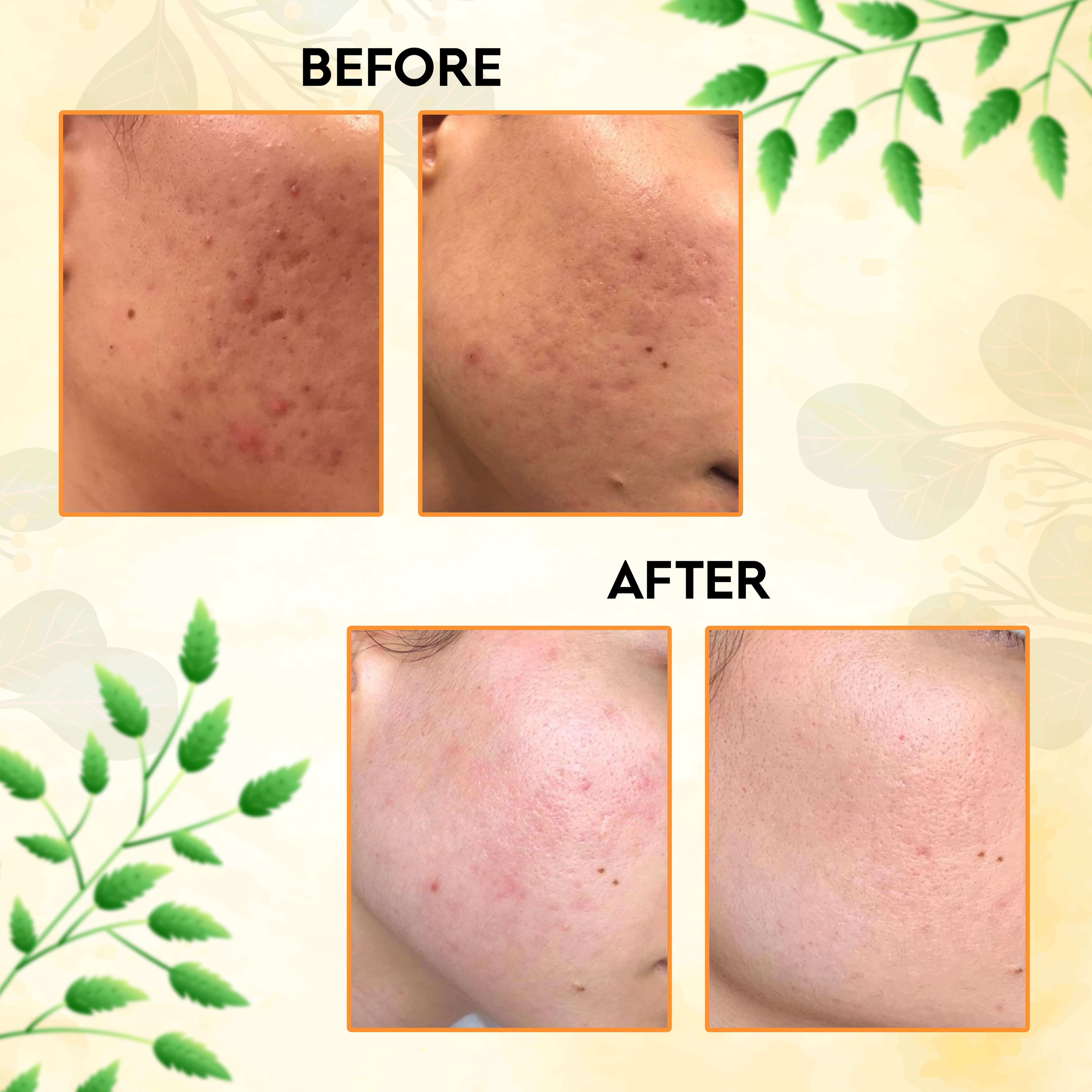 Before and after images showing skin improvement using AyuRaksha Herbal Antibacterial Bath Powder with natural ingredients.