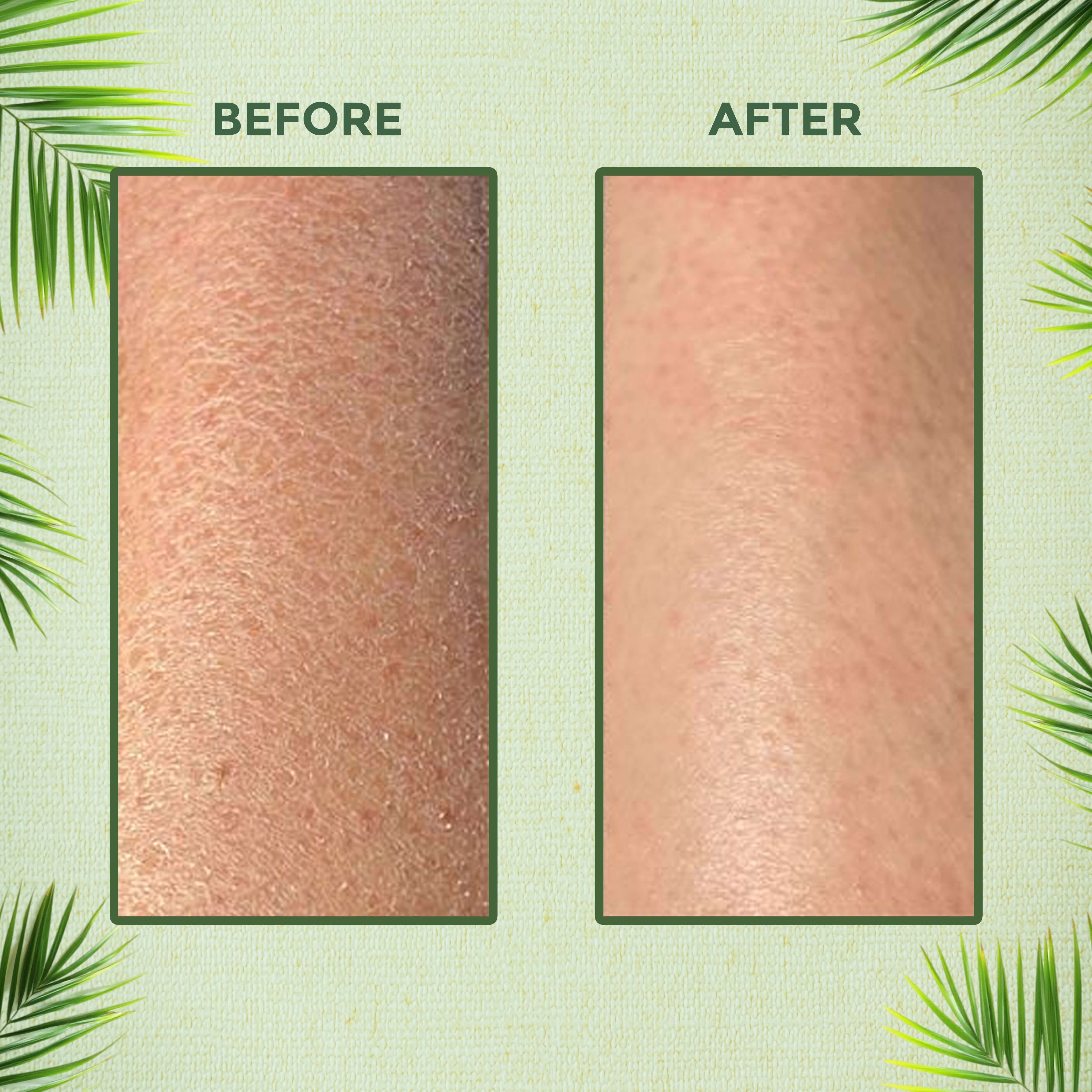 Comparison of skin texture before and after using NeemLush Herbal Neem Face Wash by Aayogi Ayurveda.