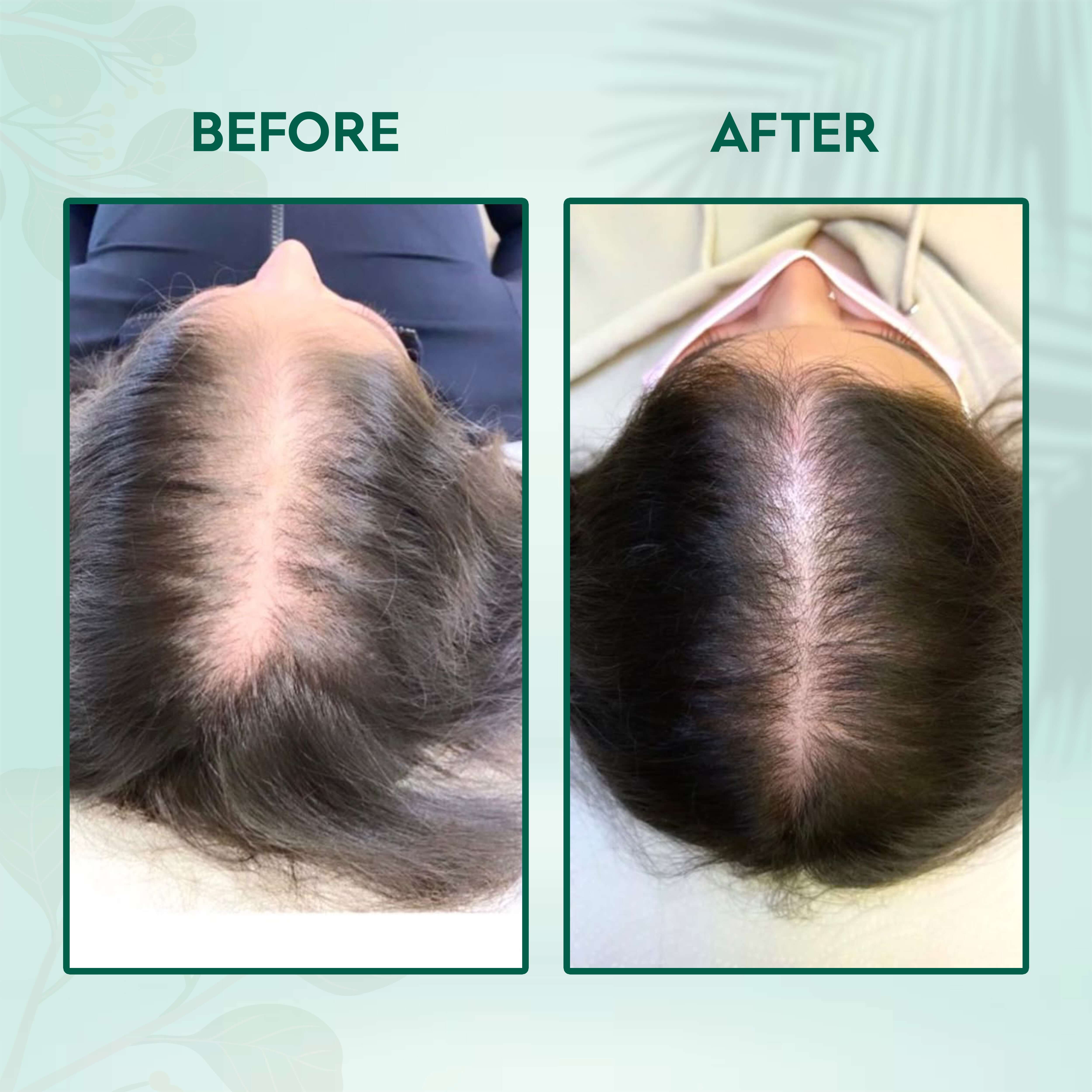Before and after image showing scalp improvements with ClearScalp Herbal Dandruff Powder by Aayogi Ayurveda.