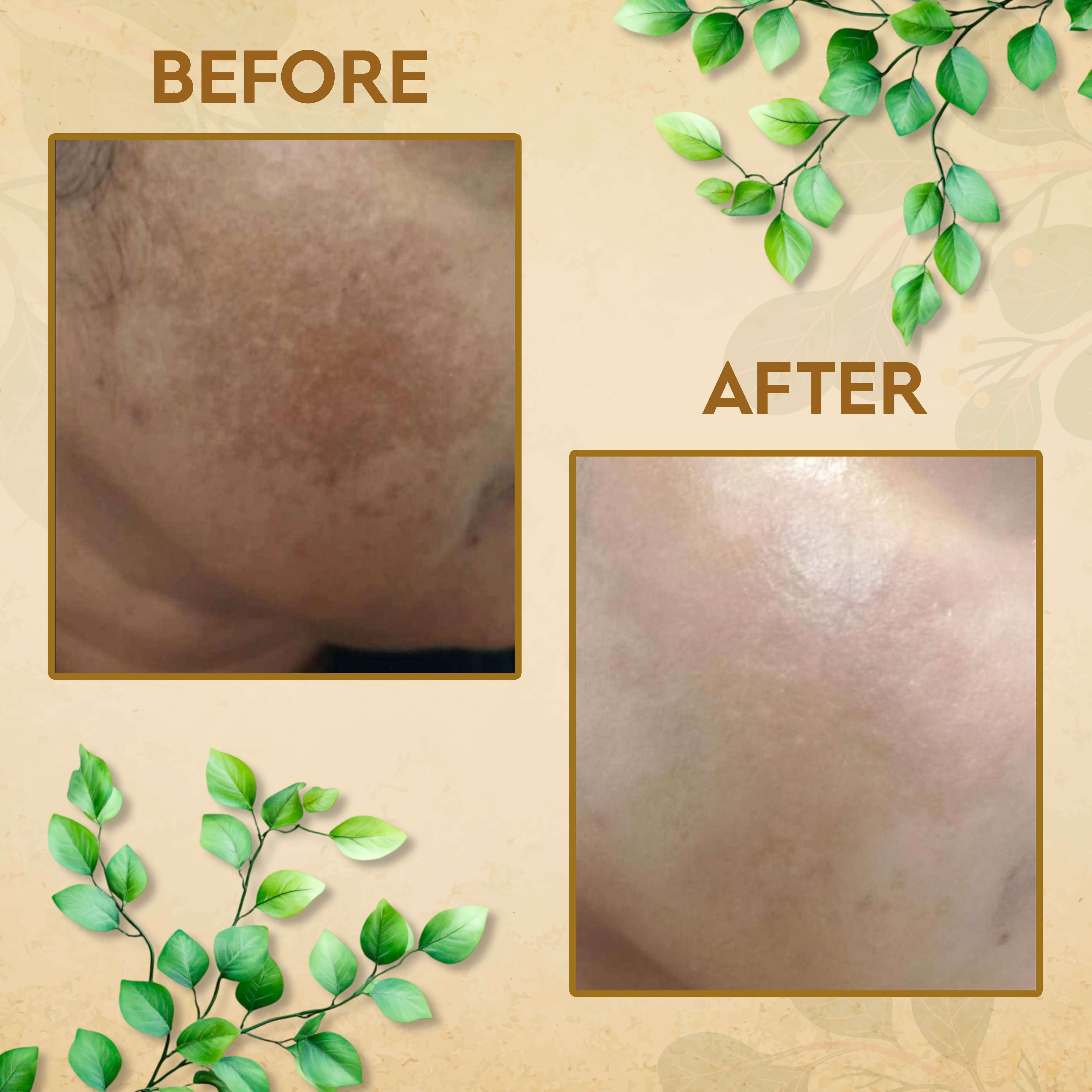 Before and after results of using GlowVeda Herbal Bath Powder by Aayogi Ayurveda for skin brightening and natural glow.