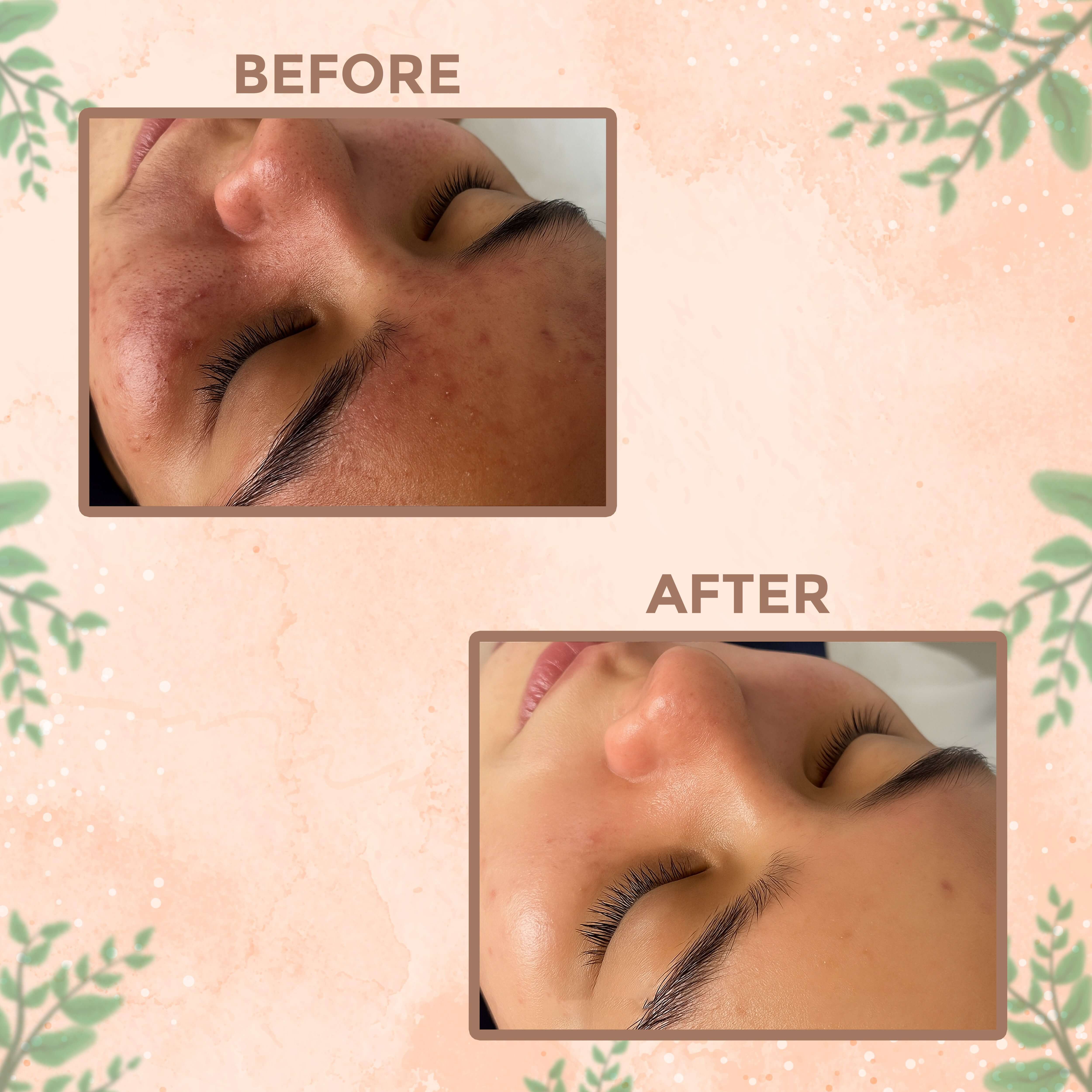 Before and after using Peelush Orange Peel Face Wash showing clearer, glowing skin.