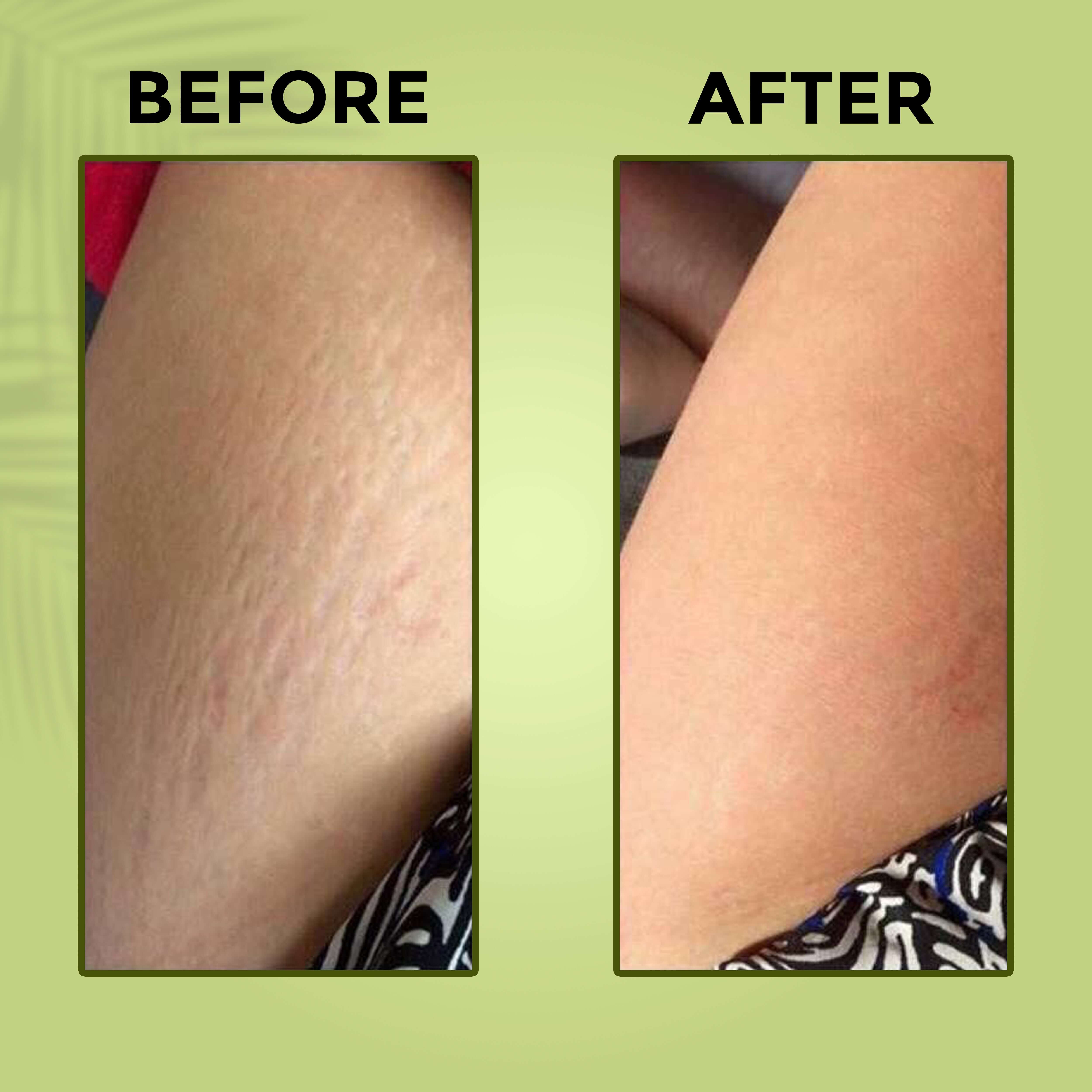 Before and after results using Prakriti Bath Sunni Pindi Herbal Bath Powder showing improved skin texture and health.